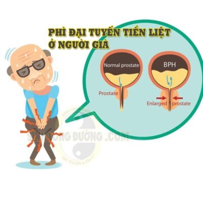 Benh Phi Dai Tuyen Tien Liet O Nguoi Gia Anh Dai Dien