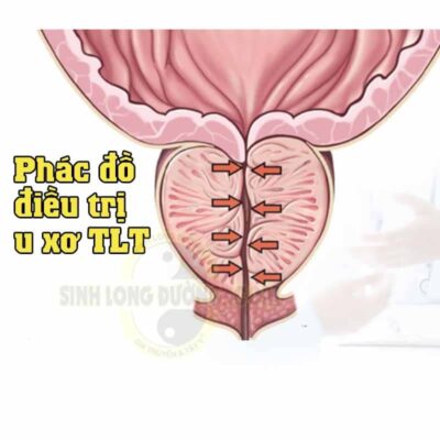 Phac Do Dieu Tri U Xo Tien Liet Tuyen