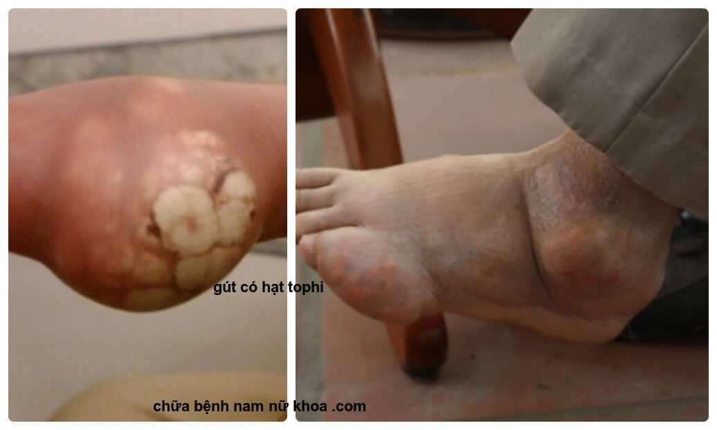 gout